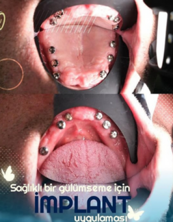 İmplant Tedavisi